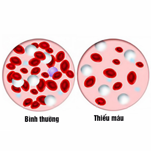 Thiếu máu cục bộ